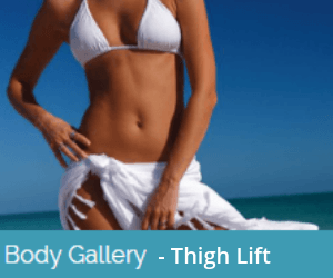 Thigh Lift Gallery in Sacramento & Granite Bay