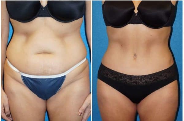 How Much Does Tummy Tuck (Abdominoplasty) Cost? (See Prices Near