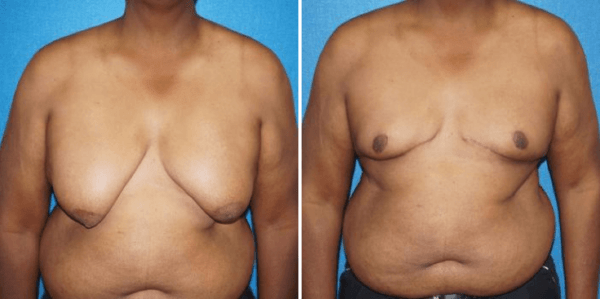 What is the Difference Between a Breast Lift and a Breast Augmentation? -  Dr Rudy Coscia