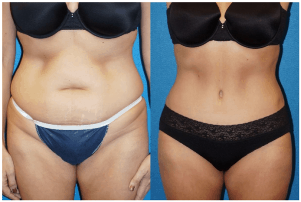 Tummy Tuck Sacramento Before and After Photos