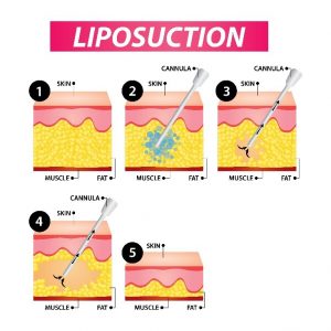 Liposuction Procedure Granite Bay