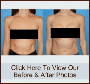 Breast Implant Patient Before and After Photos