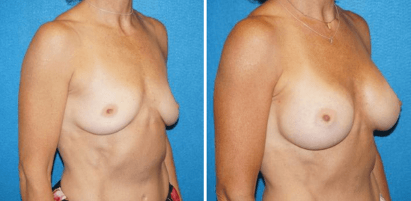 Gallery for Cosmetic Breast Surgery Patients
