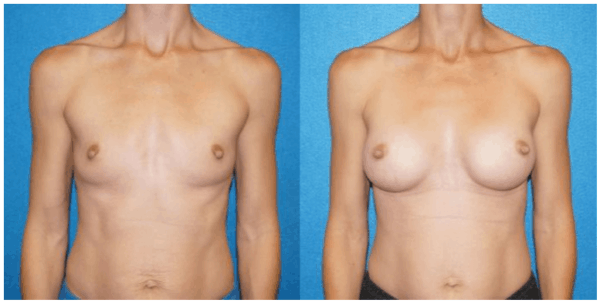Patient Gallery for Breast Augmentation