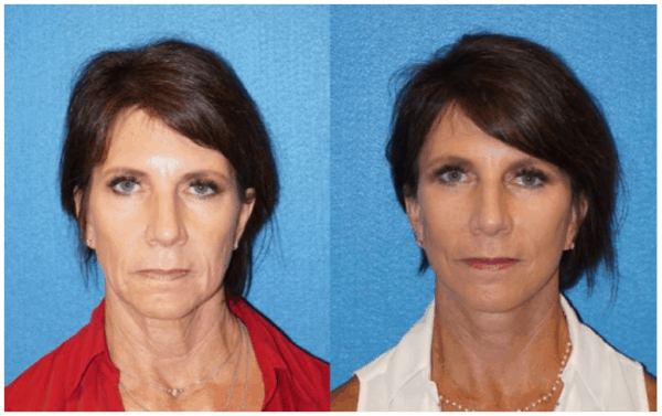 Facial Plastic Surgery Patients