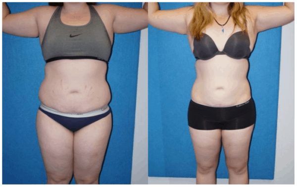 Liposuction Before After Photos