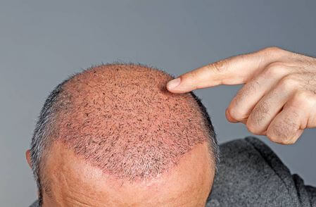 NeoGraft Hair Transplant Results