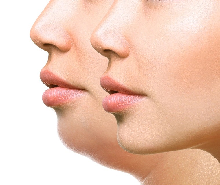 Chin Augmentation in Sacramento and Granite Bay