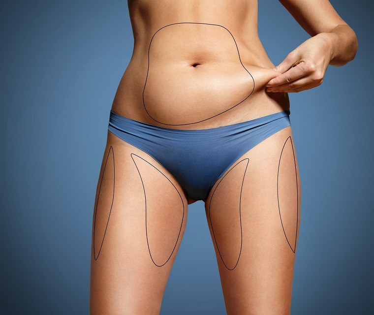 Liposuction in Sacramento & Granite Bay