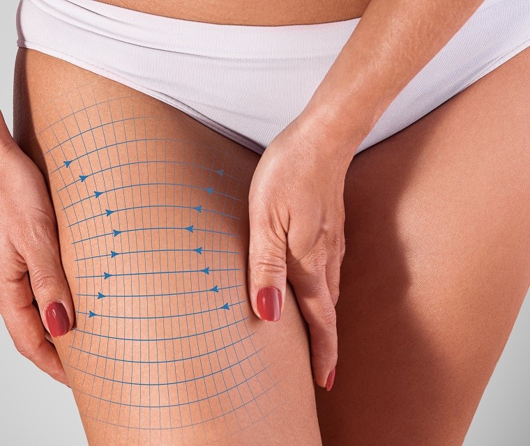 Thigh Lift in Sacramento and granite Bay